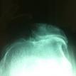 Severe Patellofemoral arthritis