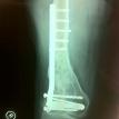 United supracondylar fracture of the femur after fixation and union