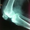 Severe Osteoarthritis knee