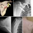 Fracture and fixation for scapular