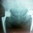 Bilateral Hip Replacement