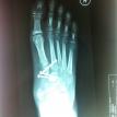 LIsfranc fracture fixed